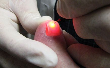 tratament cu laser de unghii incarnate