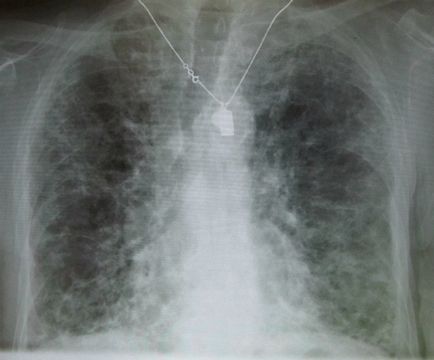 desen pulmonar întărit ceea ce înseamnă să fluoroscopie