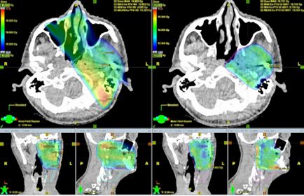 Radioterapia in oncologie pentru tratamentul cancerului și a consecințelor sale