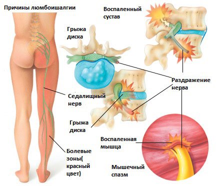 Cauze sciatica, semne, simptome, tratament