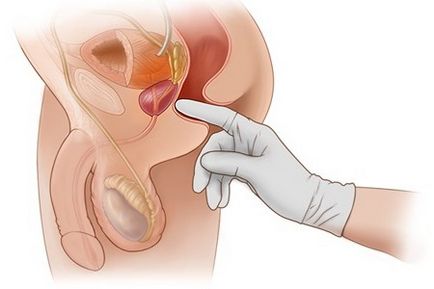 Masaj pentru tratamentul prostatitei la echipamente performante acasă