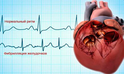 Atrial tahiaritmiile ce este, simptome și tratament