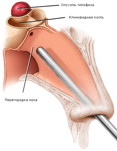 Microadenom hipofiza cauze, simptome si tratamente