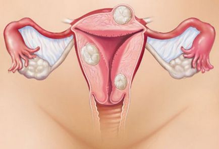 fibrom uterin - semne, simptome, tratament