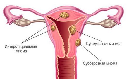 fibrom uterin - semne, simptome, tratament