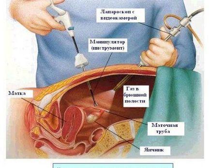 fibrom uterin - semne, simptome, tratament