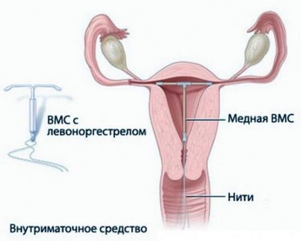 fibrom uterin - semne, simptome, tratament