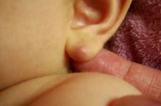 Lobul urechii - ce este, funcția sa și în cazul în care