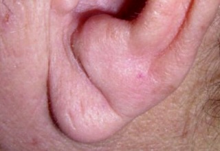 Lobul urechii - ce este, funcția sa și în cazul în care