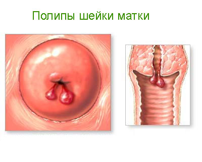Poate sângerare eroziune de col uterin ce sa faca, cauze si tratament