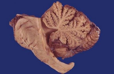 cerebel cerebral