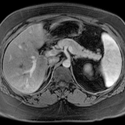 IRM a pancreasului, care arată modul de a face