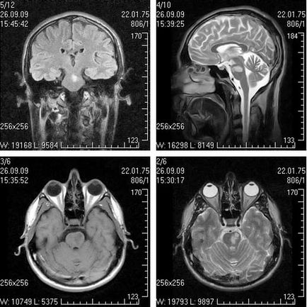 RMN in scleroza multipla
