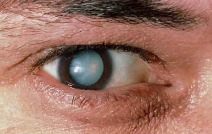 remedii populare pentru cataracta, în etapa inițială, și că va