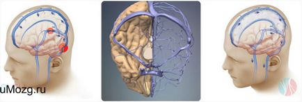 Violarea cerebrale venoase simptome de evacuare, tratament, medicamente pentru distsirkulyatsii