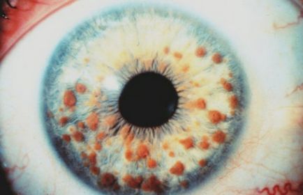 nev coroidian și fotografie iris ochi, pericol, diagnostic, tratament, prognostic