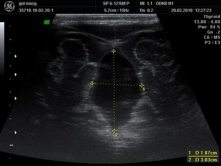 creier nou-nascuti neurosonography (grudnichka) ceea ce este, de până la ce vârstă