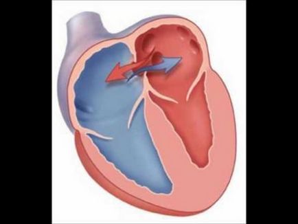 brevet foramen ovale în inima unui copil la sugari și nou-născut gaura, inima