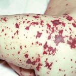 erupții Diferențele piele în boli infecțioase, foto, video