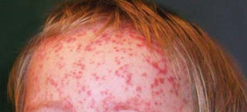 erupții Diferențele piele în boli infecțioase, foto, video (dermică) erupții Diferențele piele în boli infecțioase, foto, video