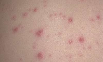 erupții Diferențele piele în boli infecțioase, foto, video (boli) erupții Diferențele piele în boli infecțioase, foto, video