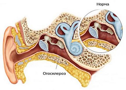 Cauze otoscleroză, simptome, tratament și de prevenire