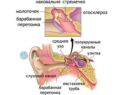 simptome otoscleroză, tratament, chirurgie