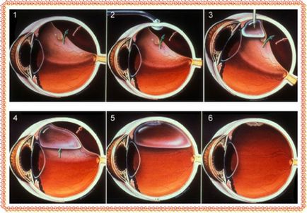 dezlipire de retina Cauzele și un tratament mai bun
