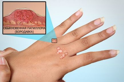 Papiloma, tratament și cauzele privind modul de a trata virusul HPV la om