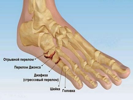 Fractura degetului mic pe semne piciorul, simptomele si tratamentul de remedii populare