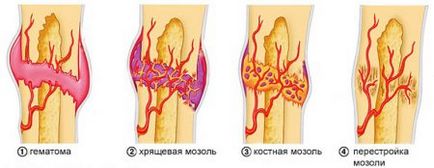 Fractura degetului mic asupra simptomelor sale picior, ce să facă, cum să se vindece repede acasă