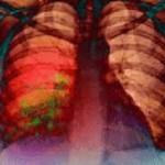 aglomerărilor și aderențe pleurale, boli pulmonare