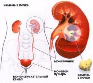 simptome colica renală, tratament, alfabet de sănătate