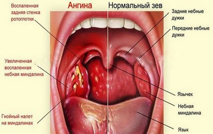 De ce doare rădăcina limbii atunci când înghițire, cauze si tratament