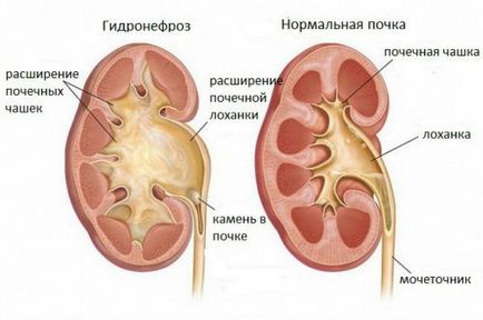 De ce doare rinichii la om, provoacă dureri în zona rinichilor