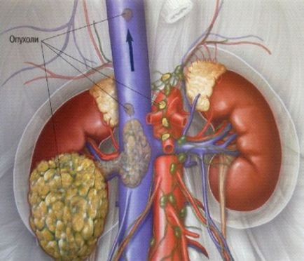 De ce doare rinichii la om, provoacă dureri în zona rinichilor