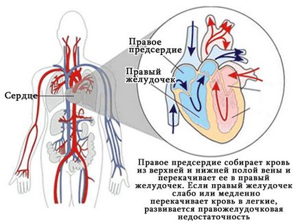 insuficiență cardiacă ventriculară dreaptă - cauze, simptome, semne, tratament, prim ajutor