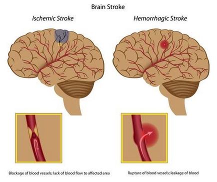 Mesagerii accident vascular cerebral - Tratamentul Inimii