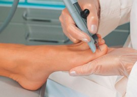 Avantajele tratamentului cu laser a unghiilor incarnate