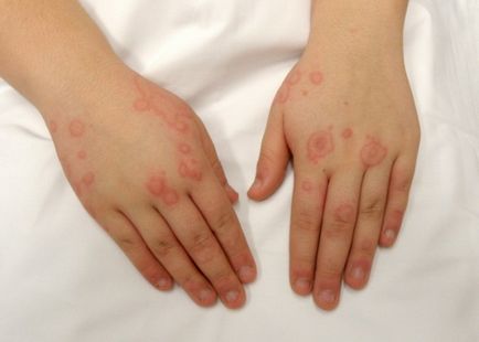 Cauzele alergiilor - apariția la adulți, urticarie, pe gat, palmele, pielea de pe fata