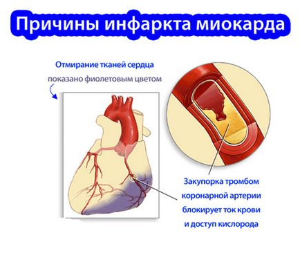 Cauzele infarct miocardic - la bărbați, la femei, de la ceea ce se întâmplă, de ce acolo,