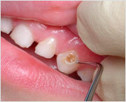 Prevenirea cariilor dentare sunt dovedite metode și mijloace