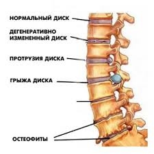 proeminență a vertebrelor