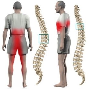 proeminență a vertebrelor