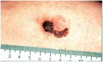 cancer de piele, melanomul - cauze, simptome si tratament
