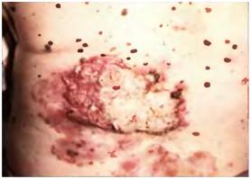 cancer de piele, melanomul - cauze, simptome si tratament