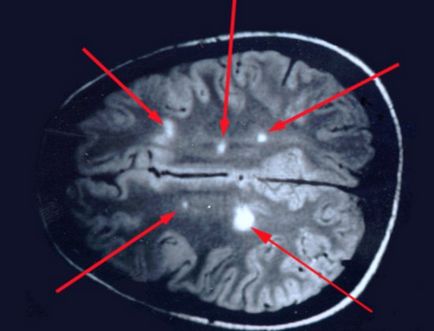 Scleroza multipla privind caracteristicile RMN si diagnosticul sclerozei multiple