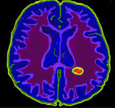 Scleroza multipla privind caracteristicile RMN si diagnosticul sclerozei multiple