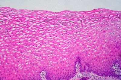 Descifrarea rezultatele biopsii cervicale