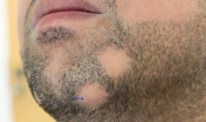 Neuniforma în creștere o barbă, ce se întâmplă dacă cresc în locuri, patch-uri de ce într-un singur loc